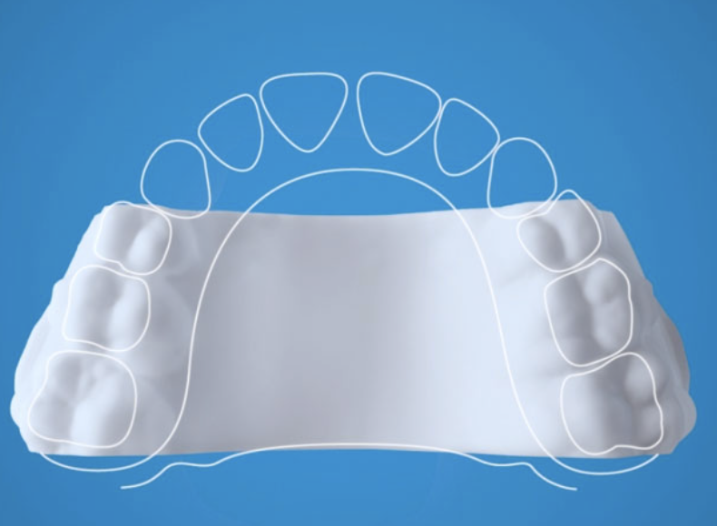 Invisalign palatal expander